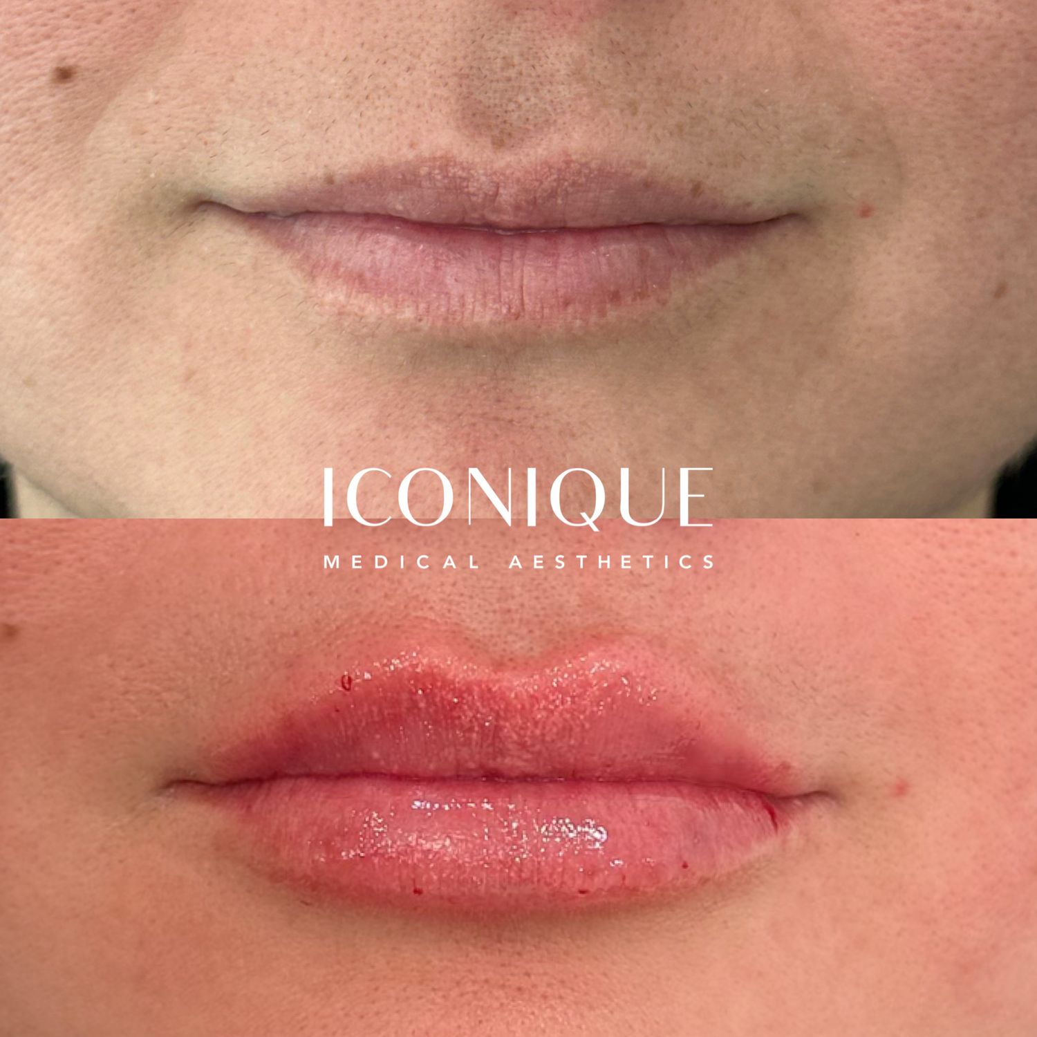 Lip Filler Before & After