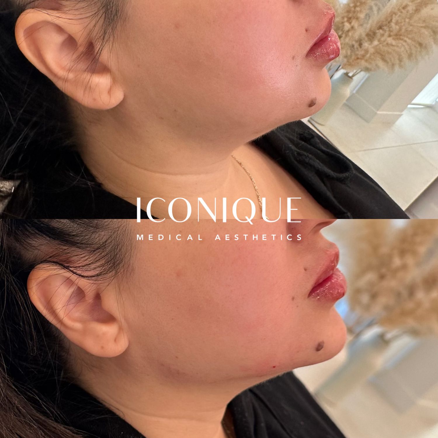 Jawline Filler Before & After