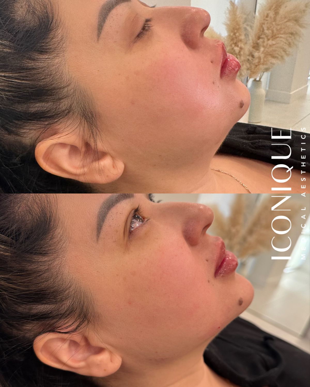 Jawline Filler Before & After
