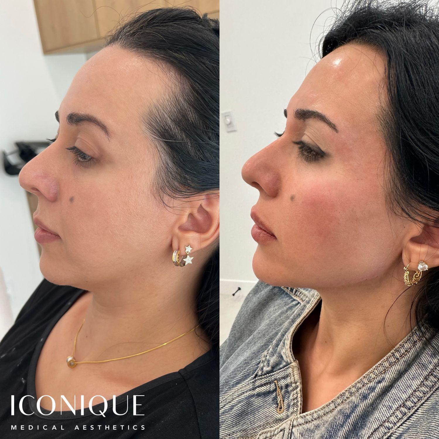 Jawline Filler Before & After