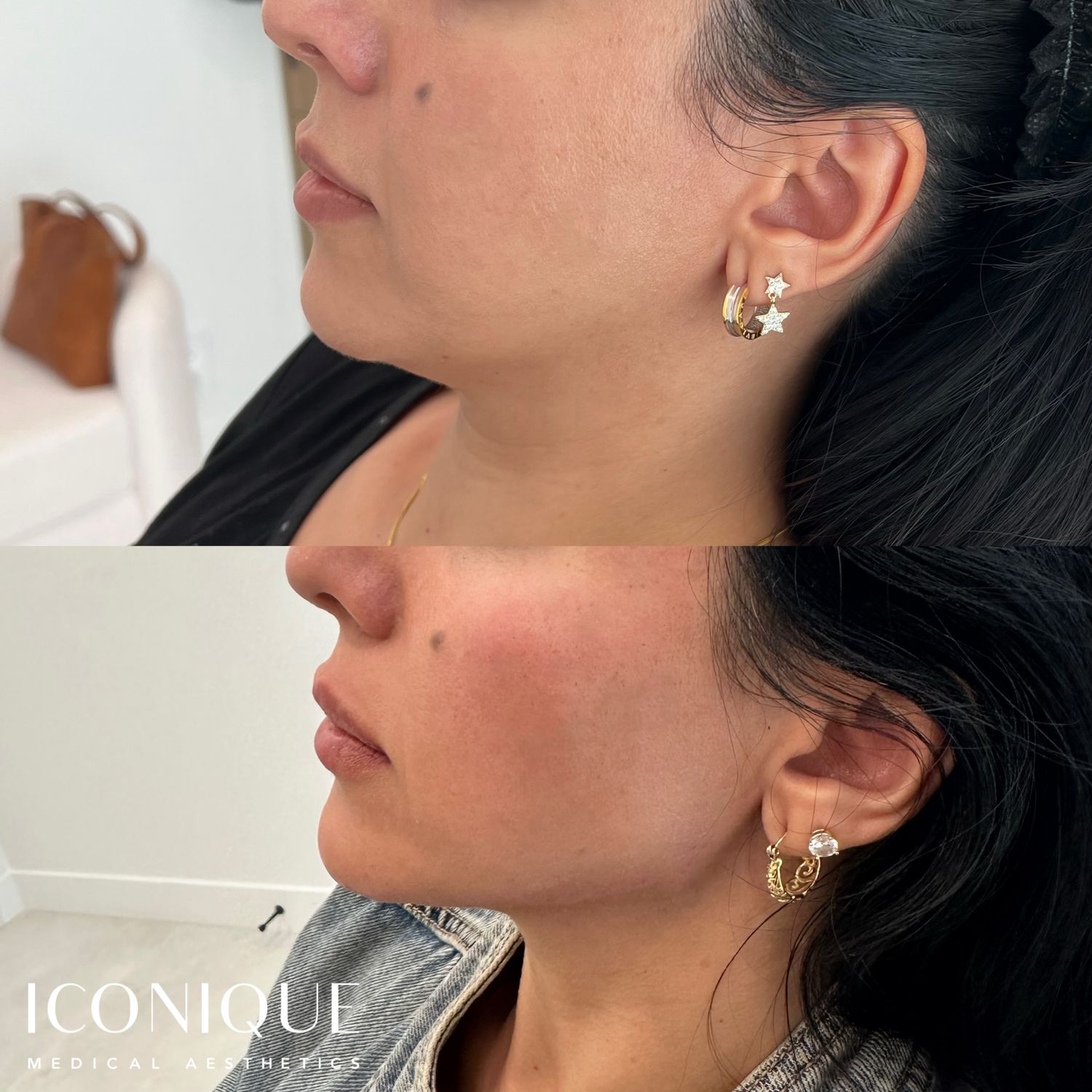 Jawline Filler Before & After