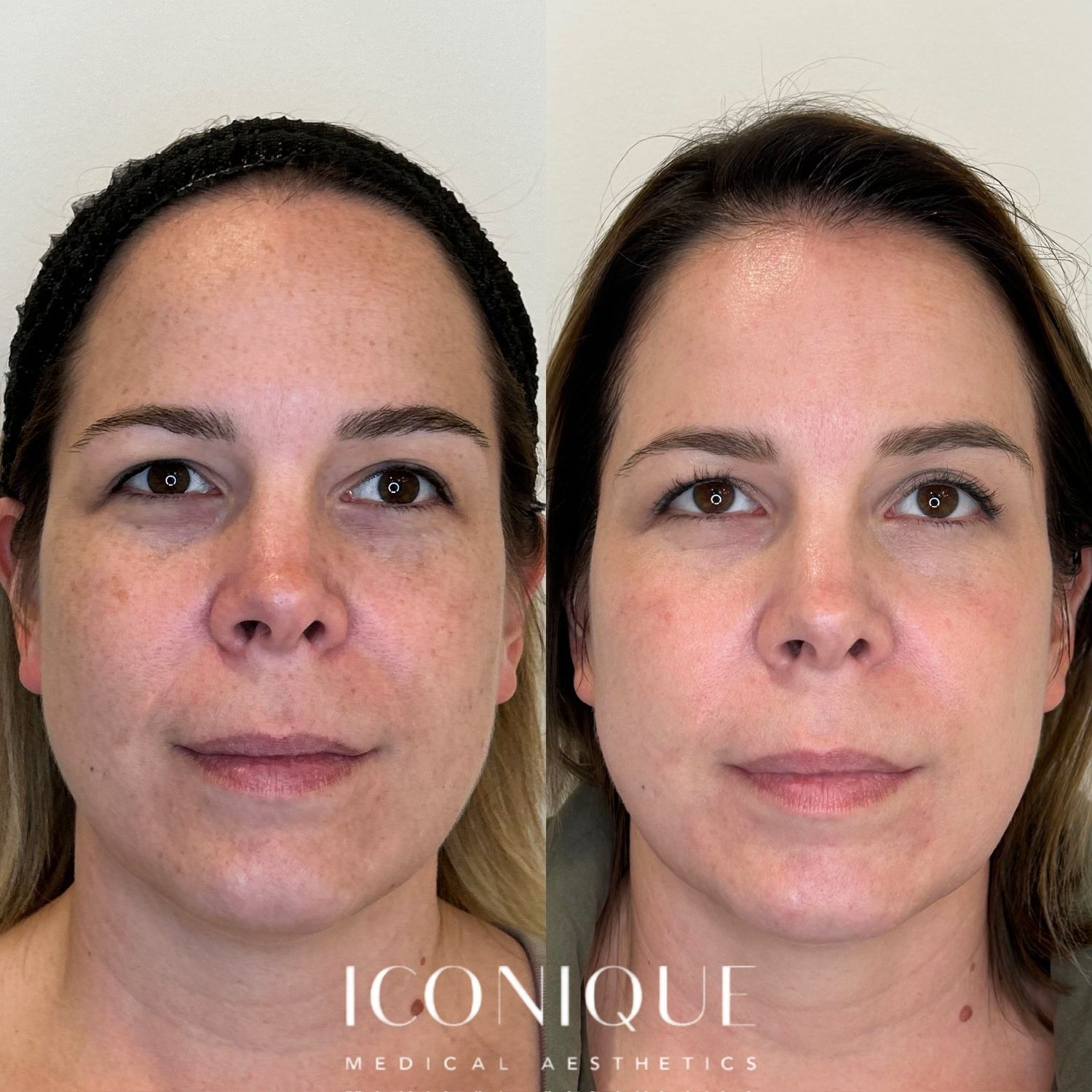 Laser Treatment Before & After