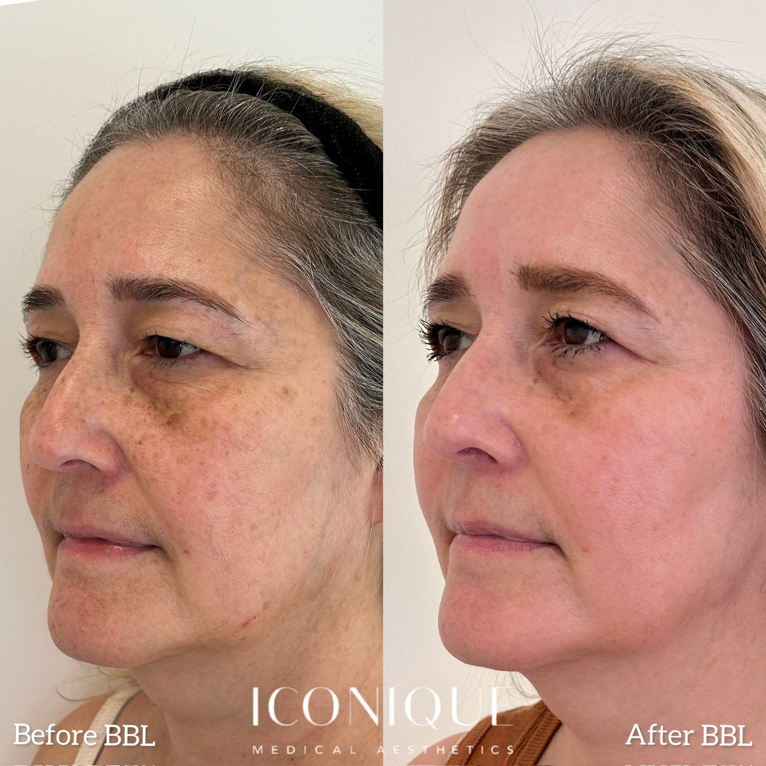 Laser Treatment Before & After