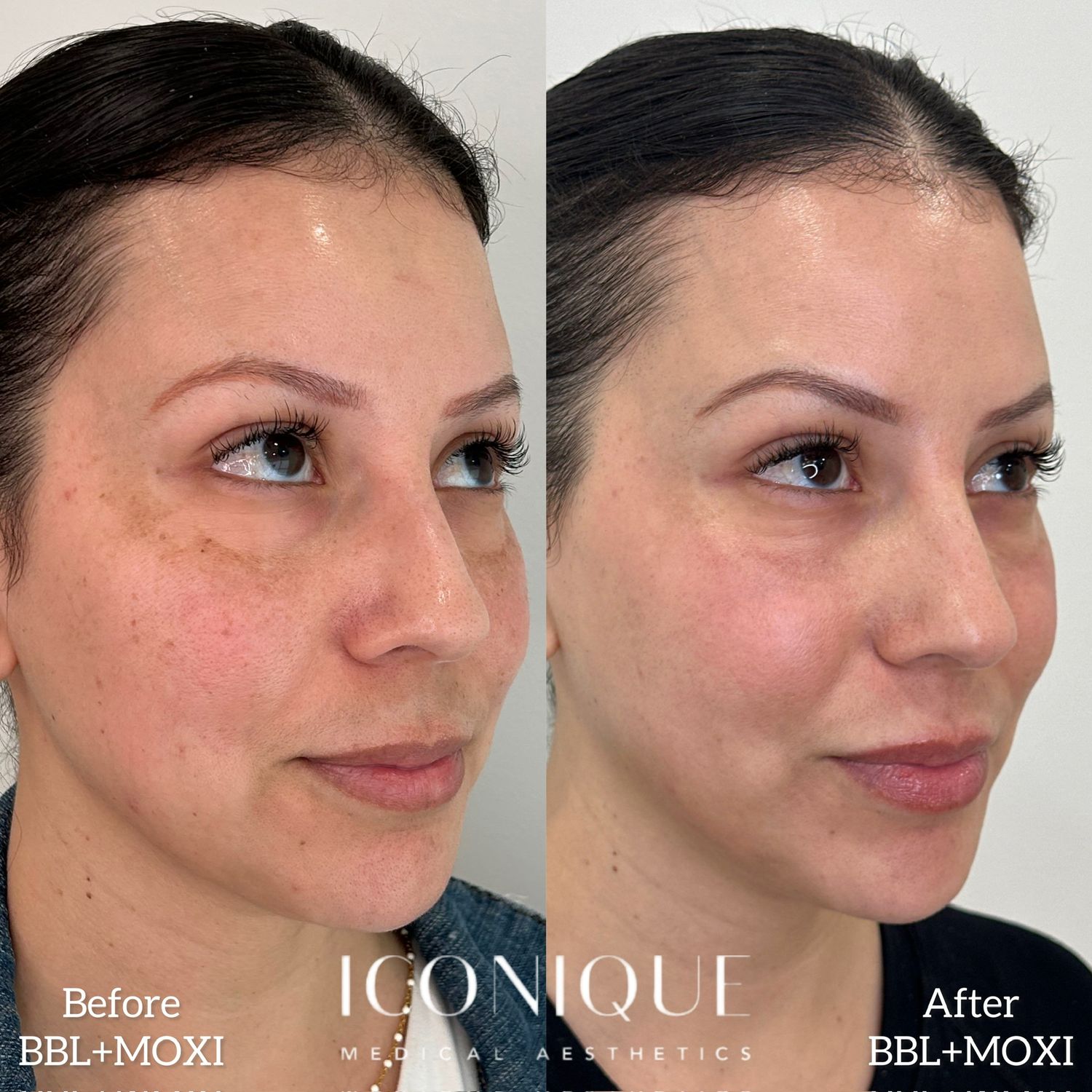 Laser Treatment Before & After