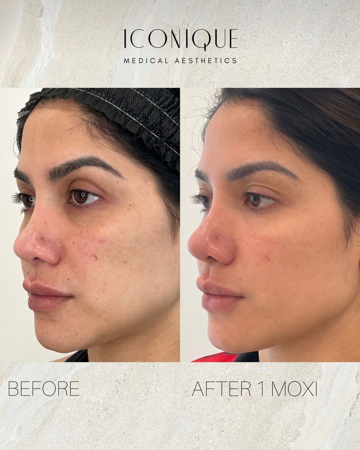 Laser Treatment Before & After