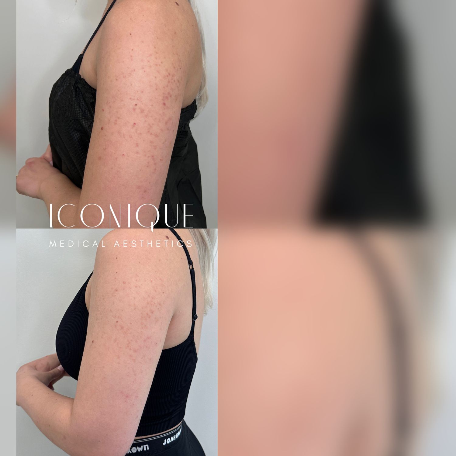 Laser Treatment Before & After