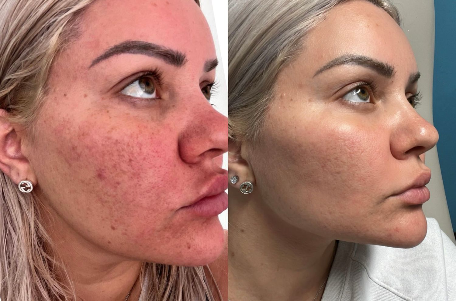 Laser Treatment Before & After